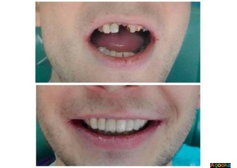Высококачественное протезирование зубов - несъемные и съемные протезы